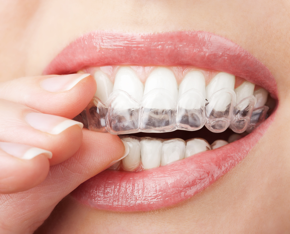 Invisalign And Clear Aligners at Union Family Dental