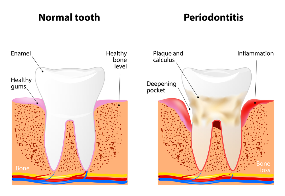Periodontal Treatment at Union Family Dental